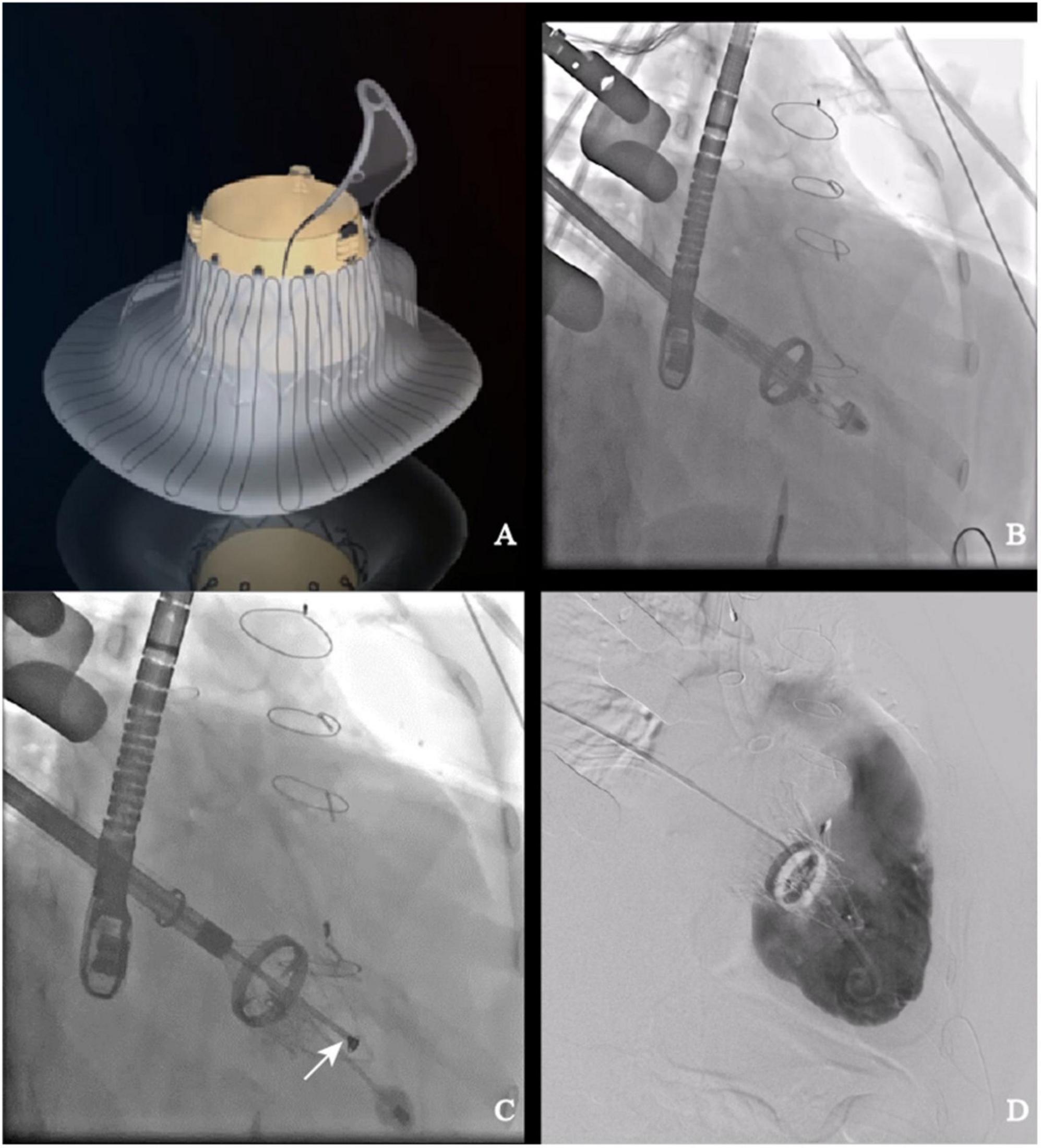Outcomes of minimally invasive isolated tricuspid valve reoperation after left-side valve surgery: A single-center experience
